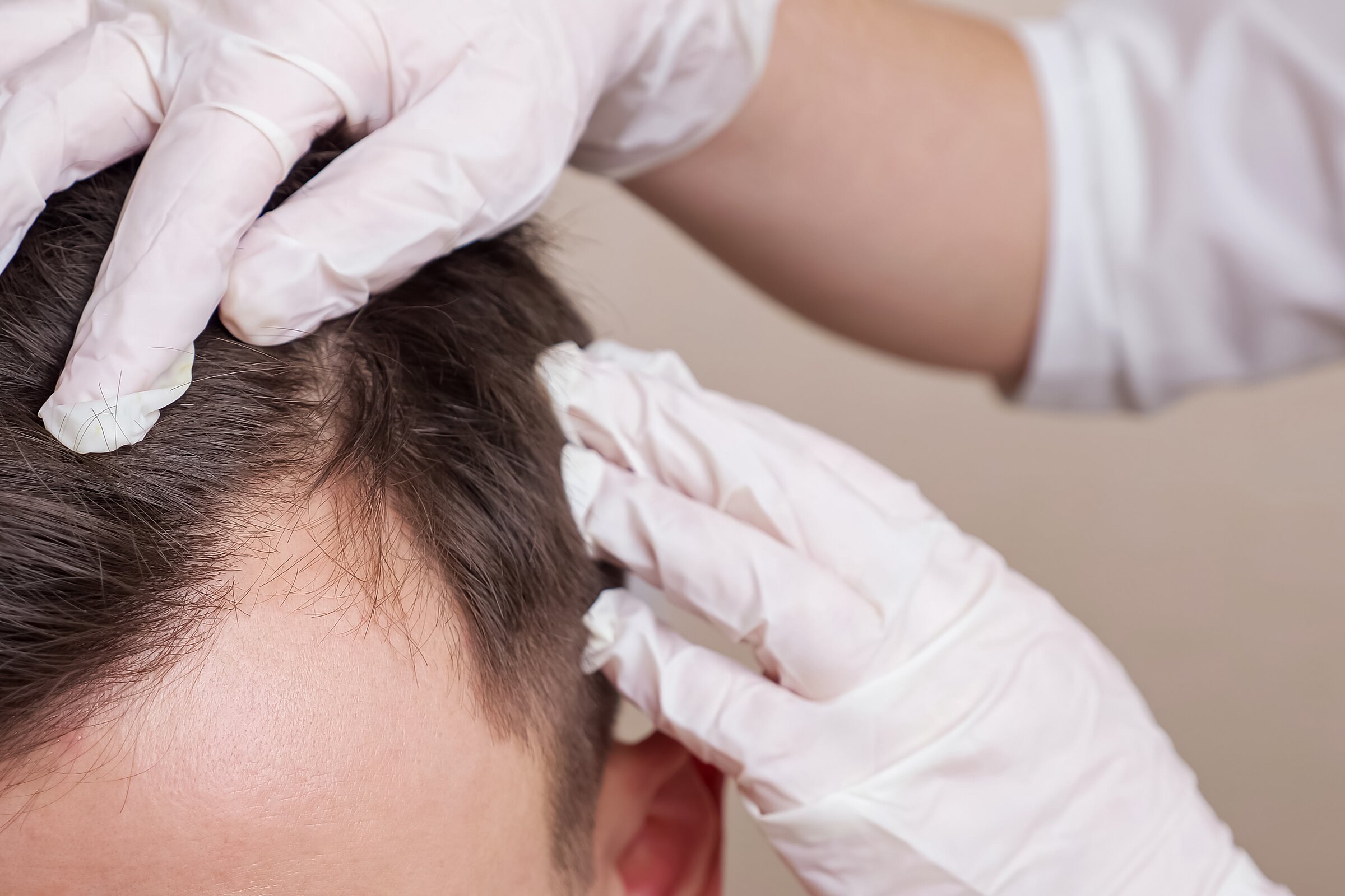 Luizenkam en middelen tegen hoofdluis bij Medische Haarstudio Nauta